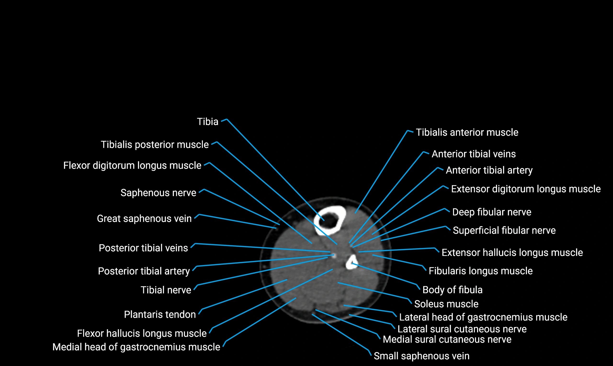 CT lower limb axial cross sectional anatomy labelled image 113 (2).webp